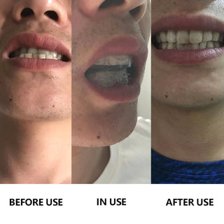 teeth straightening kit